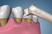 OHI Proxi-Brush Severe Bone Loss